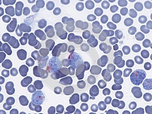 Acid phosphatase in a case of T lymphoblastic leukemia photo