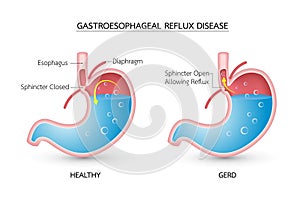 Gastroesophageal reflux disease GERD.