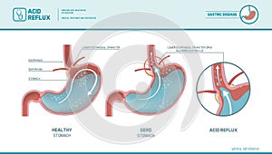 Acid reflux and heartburn infographic