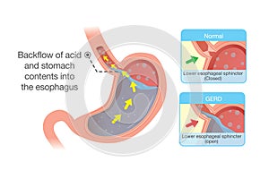 Acid in stomach back up into esophagus photo