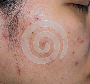 Acne and acne spot on oily face skin of Asian woman. Concept before acne treatment and face laser treatment for get rid of dark