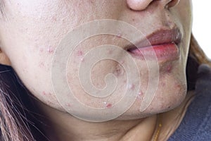 Acne , black spots and scars on face