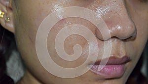 Acne , black spots and scars oily on face of Asian young woman