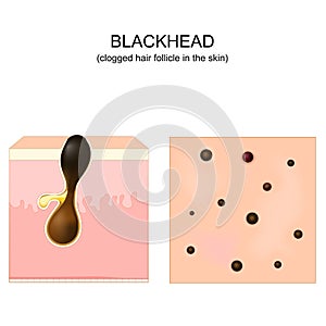 Acne. blackhead. clogged pore. Cross-section of a human skin