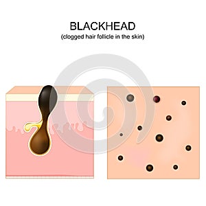 Acne. blackhead. clogged pore. Cross-section of a human skin photo