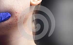 Acne on the chin: demodecosis tick on the skin of a girl`s face. Patient at the appointment of a dermatologist. Problem skin and