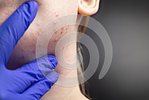 Acne on the chin: demodecosis tick on the skin of a girl`s face. Patient at the appointment of a dermatologist. Problem skin and