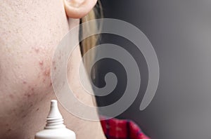 Acne on the chin: demodecosis tick on the skin of a girl`s face. Patient at the appointment of a dermatologist. Problem skin and