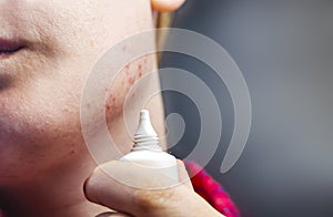 Acne on the chin: demodecosis tick on the skin of a girl`s face. Patient at the appointment of a dermatologist. Problem skin and