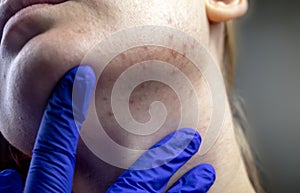 Acne on the chin: demodecosis tick on the skin of a girl`s face. Patient at the appointment of a dermatologist. Problem skin and