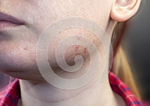 Acne on the chin: demodecosis tick on the skin of a girl`s face. Patient at the appointment of a dermatologist. Problem skin and