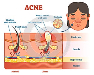 Acne diagram illustration with hair, pimple, skin layers and structure. Female face alongside. Educational medical informat