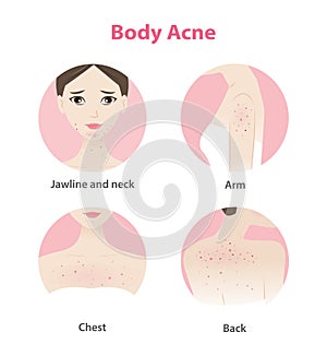 Acne on face and body woman vector icon set on white background.