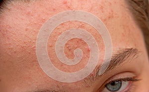 Acne forehead photo