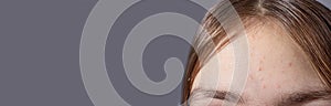 Acne on the forehead of a teenage girl - skin problems in children, acne treatment in dermatology. Banner gray copy space for text
