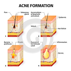 Acne formation