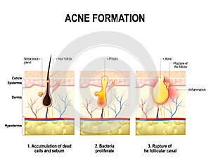 Acne formation. human skin.