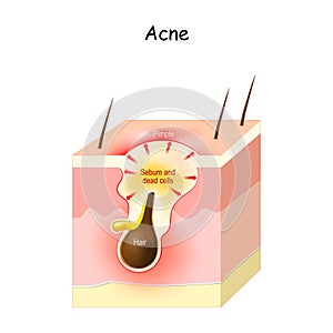 Acne Formation. Papule and pimple