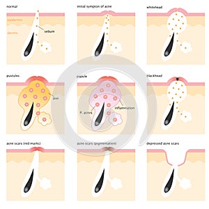 Acne formation process
