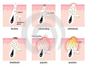 Acne formation process skin layer. types of acne. Healthy skin, sebum plug, whitehead, blackhead, Papules, and Pustules.skin care