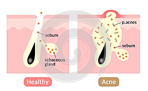 Acne formation process. types of acne. Healthy skin, sebum plug, whitehead, blackhead, Papules, and Pustules.skin care concept