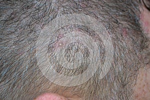 acne in the hair problem skin in men alergy