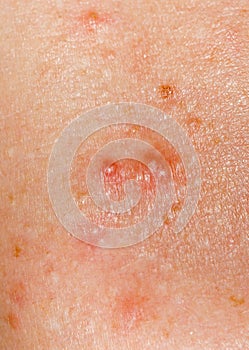 Acne on human skin