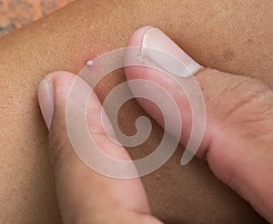 Acne on a Male Arm