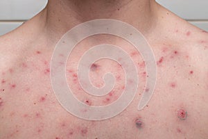 Acne on a chest. result of using steroids and anabolics photo