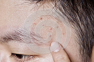 Acne Mechanica or sports-induced acne or whiteheads or mild acne at forehead