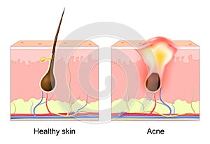 Acne pimple. normal hair follicle and clogged pore