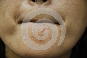 Akné nebo pupínek obstrukce na brada z ženy 