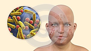 Acne, pimples in an overweight person