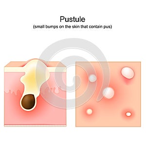 Acne. Pustule. Cross-section of a human skin. Hair follicle with pus photo