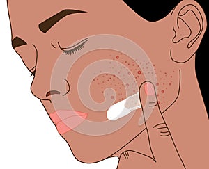 Acne or pustule on tan women\'s face used skin care treatment, illustration on white background