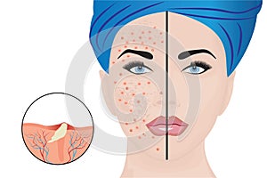 Acne pustules on a woman face and a treatment result