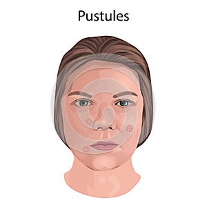 Acne. Pustules. Young woman face with skin inflammation.