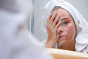 Acne. A sad teenage girl. Problematic skin in adolescents