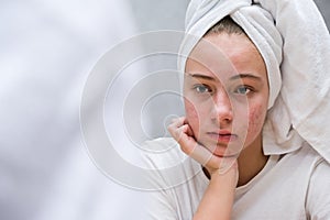 Acne. A sad teenage girl. Problematic skin in adolescents