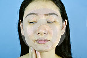 Acne scar skin facial problem, Asian woman annoy and bored about hormonal pimples.