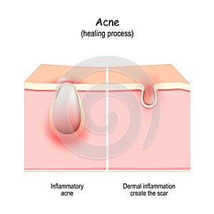 Acne scars. Abnormal healing of pimple