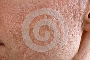 Acne scars on cheek