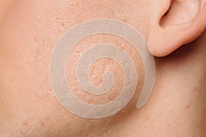 Acne scars on the face