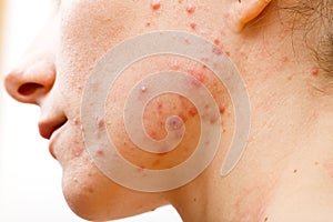 Acne skin photo