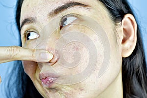 Acne skin problem, Asian woman annoy and bored about hormonal pimples.
