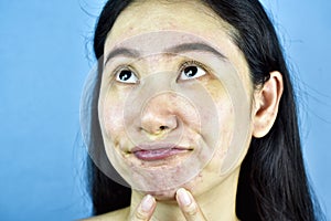 Acne skin problem, Asian woman annoy and bored about hormonal pimples.