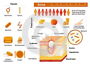 Acne. skin problems. medicine in medical infographics.