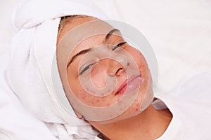 Acne. A smiling teenage girl with pimples on her face. Facial skin care