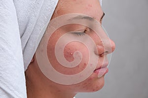 Acne. Teenage girl with the pimples on her face. Close-up. Problematic skin in adolescents