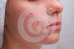 Acne. Teenage girl with the pimples on her face. Problematic skin. Close-up